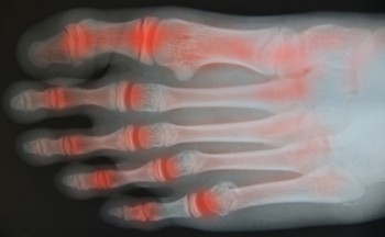 Causes and Relief From Toe Arthritis