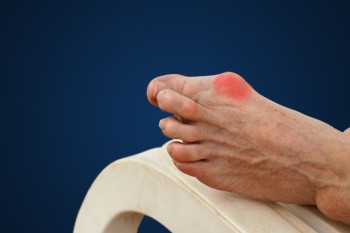 The Truth About Bunions