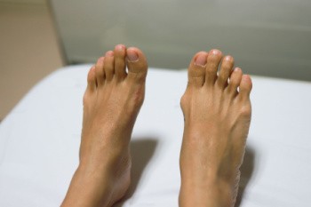 Exploring Various Types of Bunions